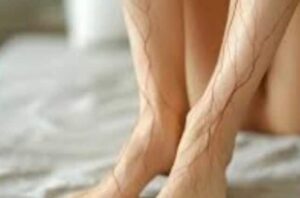 Spider Veins: पैरों में दिखने वाली नीली-लाल रेखाएं क्या गंभीर बीमारी का संकेत हैं?